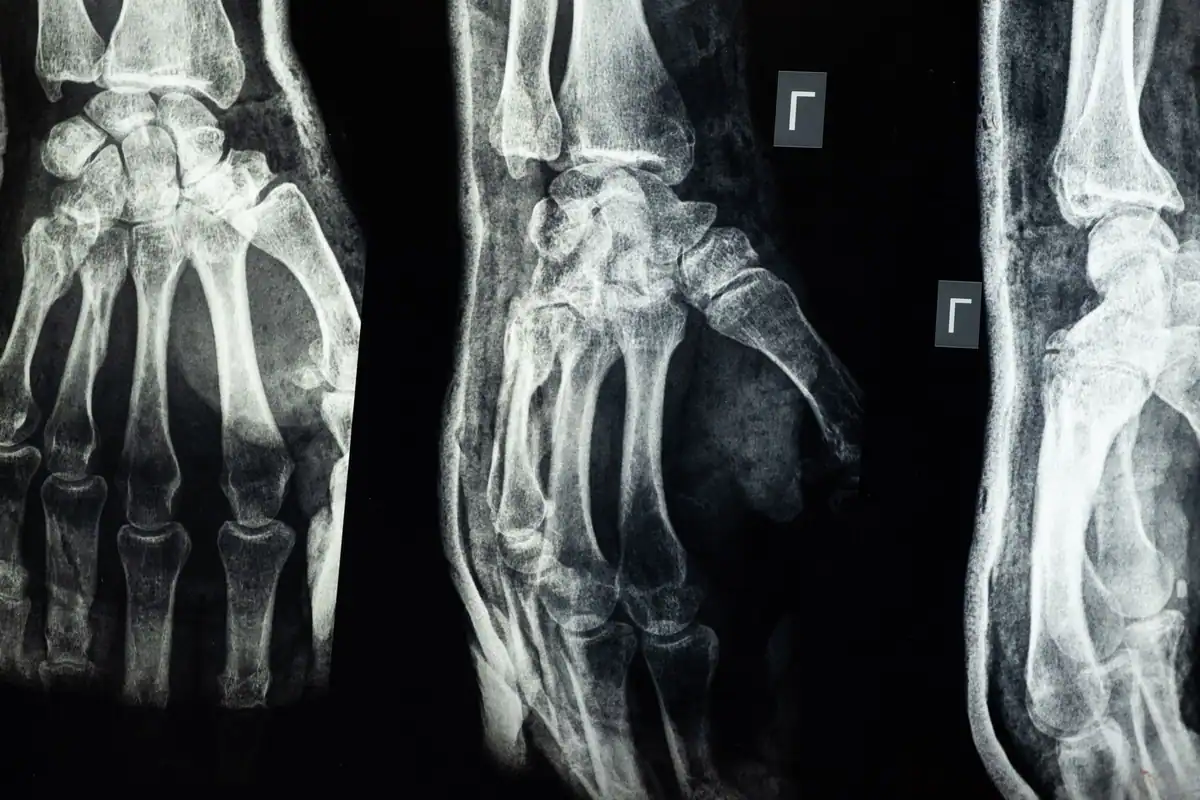 Radiografii ale oaselor mâinii, pe fundal întunecat